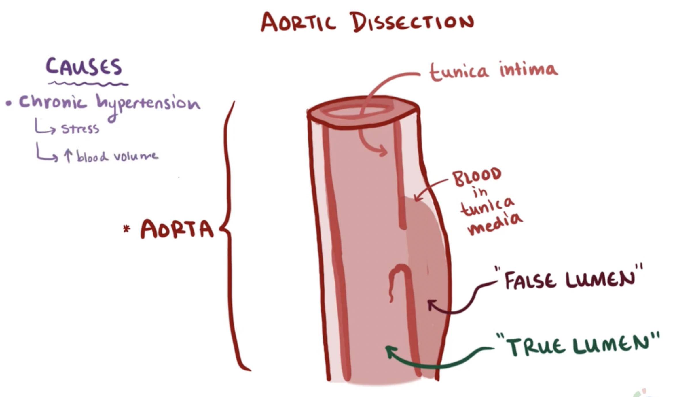 <ul><li><p>tear in the tunica intima (innermost layer) creating a false lumen/second passage for blood to flow through</p></li><li><p>centralised, sharp chest pain radiating to their back</p></li><li><p>Consequences:</p><ul><li><p><strong>organ ischemia/infarction: </strong></p><p>If blood flow in the false lumen diverts flow <em>away</em> from branch vessels (e.g., <strong>renal arteries</strong> → kidney ischemia) </p></li><li><p><strong>Cardiac tamponade</strong>: </p><p>If the dissection is in the <strong>ascending aorta</strong> or <strong>aortic arch</strong> (inside the pericardial sac)</p><p>→ blood leaks into the <strong>pericardial cavity</strong>, accumulating around and compressing the heart </p><p>→ <strong>heart can't pump properly</strong></p><p>→ death</p></li><li><p><strong>Hemothorax</strong>:  </p><p>If the aorta <strong>ruptures into the thoracic cavity</strong></p><p>→ rapid internal bleeding </p><p>→ sudden death</p></li></ul></li></ul><p></p>