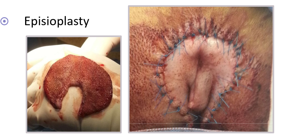 <ul><li><p>signalment </p><ul><li><p>overweight dogs </p></li><li><p>younger dogs with an infantile, recessed vulva * most commonly seen </p></li></ul></li><li><p>superficial dermatitis, urinary incontinence, recurrent urinary tract infections </p></li><li><p>episioplasty </p></li></ul><p></p>