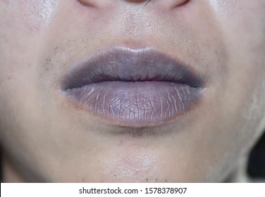 <p>cyanosis</p>