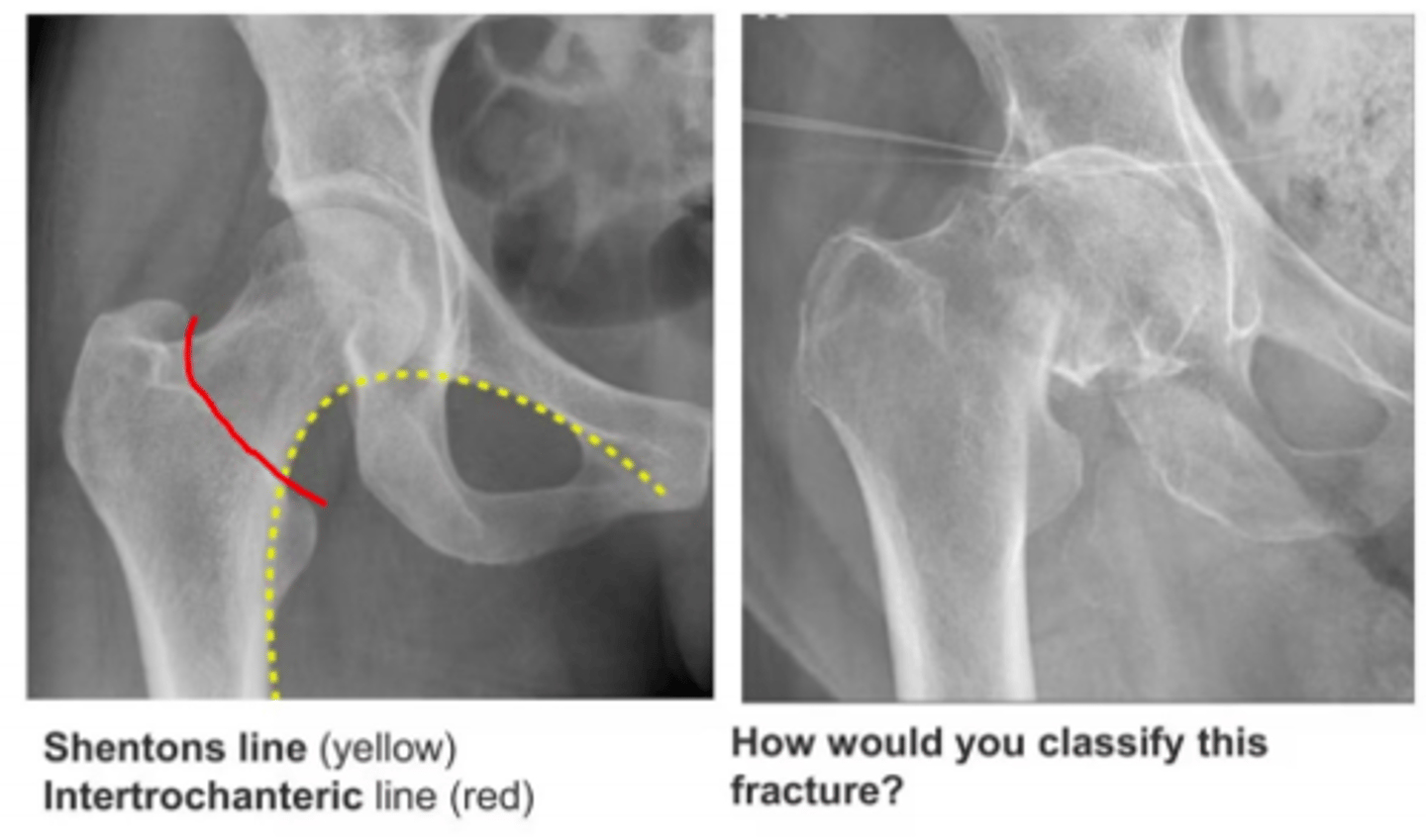 <p>How would you classify this fracture (right)</p>