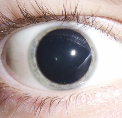 <p>4 Abnormal Findings for <strong><em>11. Inspect iris and pupil</em></strong></p><ul><li><p><strong>Dilated and fixed pupils</strong>, typically resulting from CNS injury, circulatory collapse, or deep anesthesia</p></li></ul><p></p>