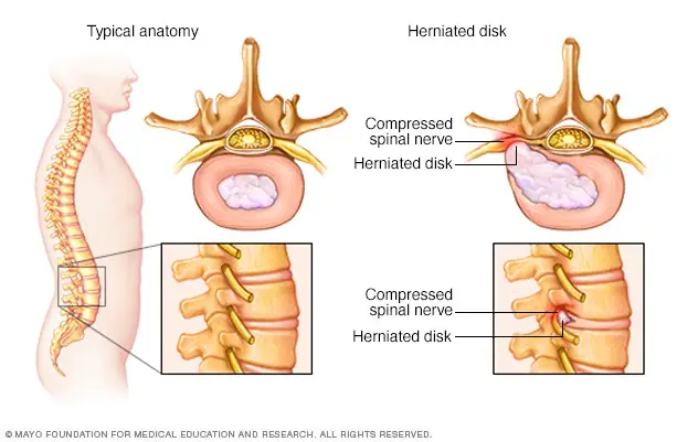 <p><span>The disks that lie between the vertebrae in the spine consist of a soft center (nucleus) surrounded by a tougher exterior (annulus). A herniated disk </span>occurs when a portion of the nucleus pushes through a crack in the annulus<span>. Symptoms may occur if the herniation compresses a nerve and include pain, numbness, tingling, or weakness in the arms, legs, or back. (</span>radiculopathy refers to symptoms produced by the pinching of a nerve in the spinal column.) </p>