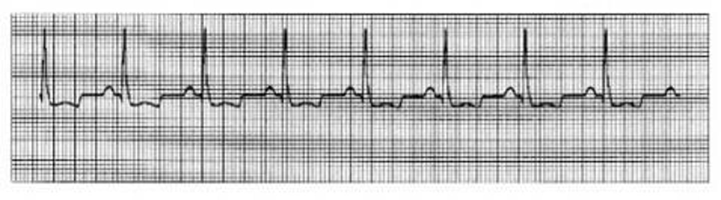 <p>Which Arrythmia is this?</p>