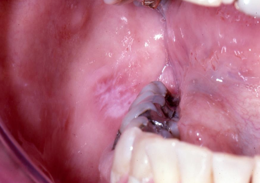 <p>What is a lichenoid amalgam reaction?</p>