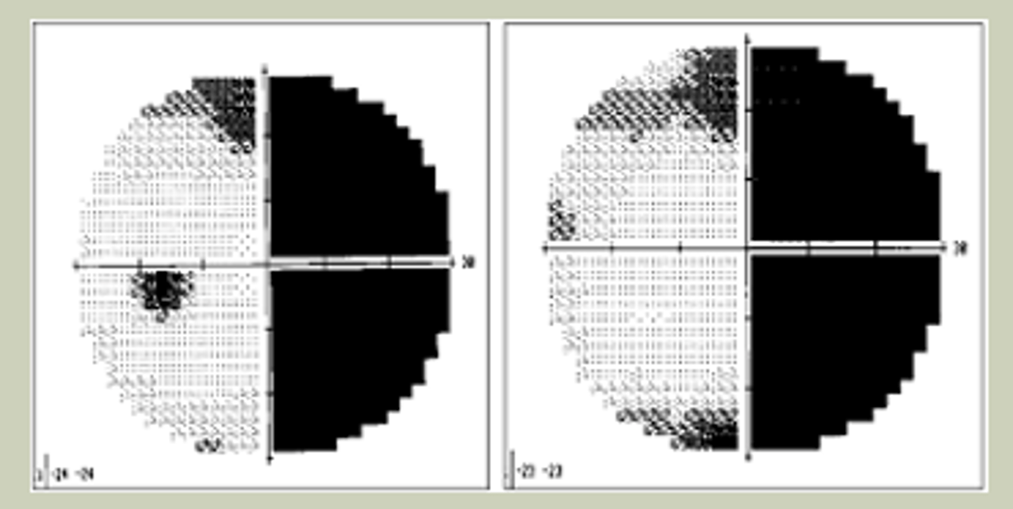 <p>-H/O CVA</p><p>-End-stage Glaucoma</p><p>-Chronic, longstanding vision loss, typically bilaterally</p><p>-Mya have mobility issues</p><p>-TX: Urgent referral to ECP</p>