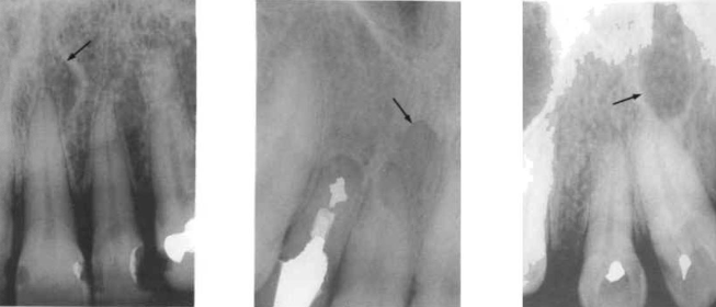 <p><span>the </span><span style="color: red;"><span>radiolucent circular shadow</span></span><span> of this foramen may be superimposed </span><span style="color: red;"><span>over the apex of a central incisor</span></span><span> and so be mistaken for a periapical lesion</span></p>