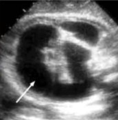 <p>Fluid filled bowel loops were seen on US. What pathology can be asusmed here?</p>