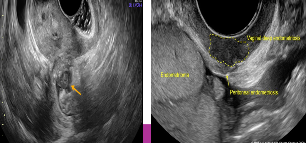 <p>Diffuse form of endometriosis is more ____ but rarely diagnosed by sonography</p>