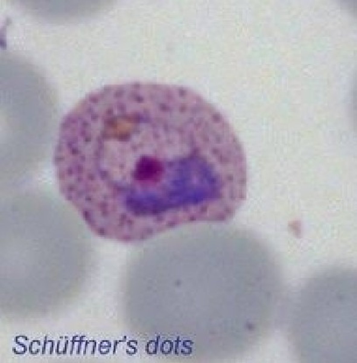 <p>• Retics infected (large RBCs)</p><p>• Ring forms >1/3 size of RBC</p><p>• Mature troph is ameboid, fills RBC</p><p>• Schizont has 12-24 merozoites</p><p>• Gametocytes are large and oval</p><p>• Schuffner's dots</p>