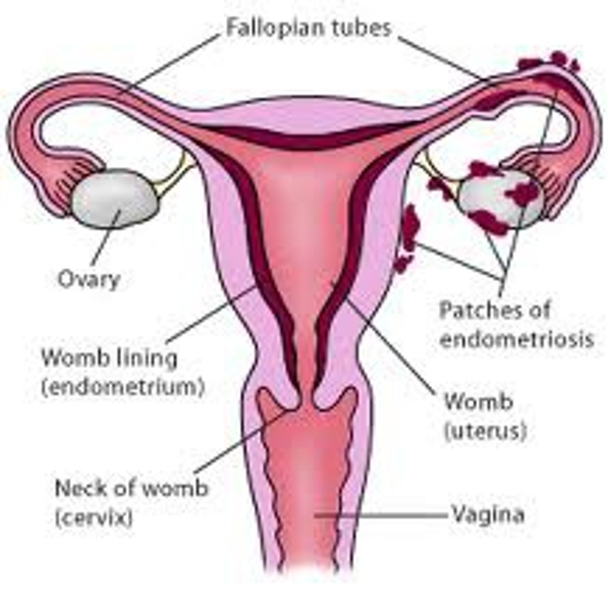 <p>tissues from the endometrium (inner lining of the uterus) that abnormally grow in other pelvic or abdominal locations like fallopian tube or ovary)</p>