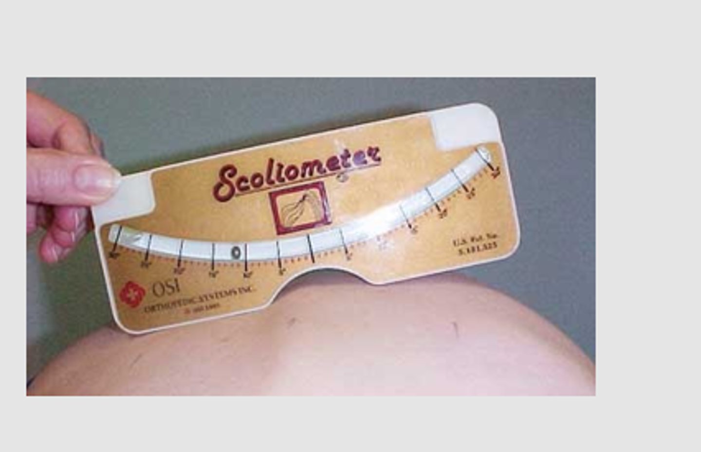 <p>Measuring device that may be used to obtain a measurement of the number of degrees that the spine is deviated in scoliosis.</p><p>7-10: just monitor</p><p>>10: needs referal</p><p>Screening tool</p>