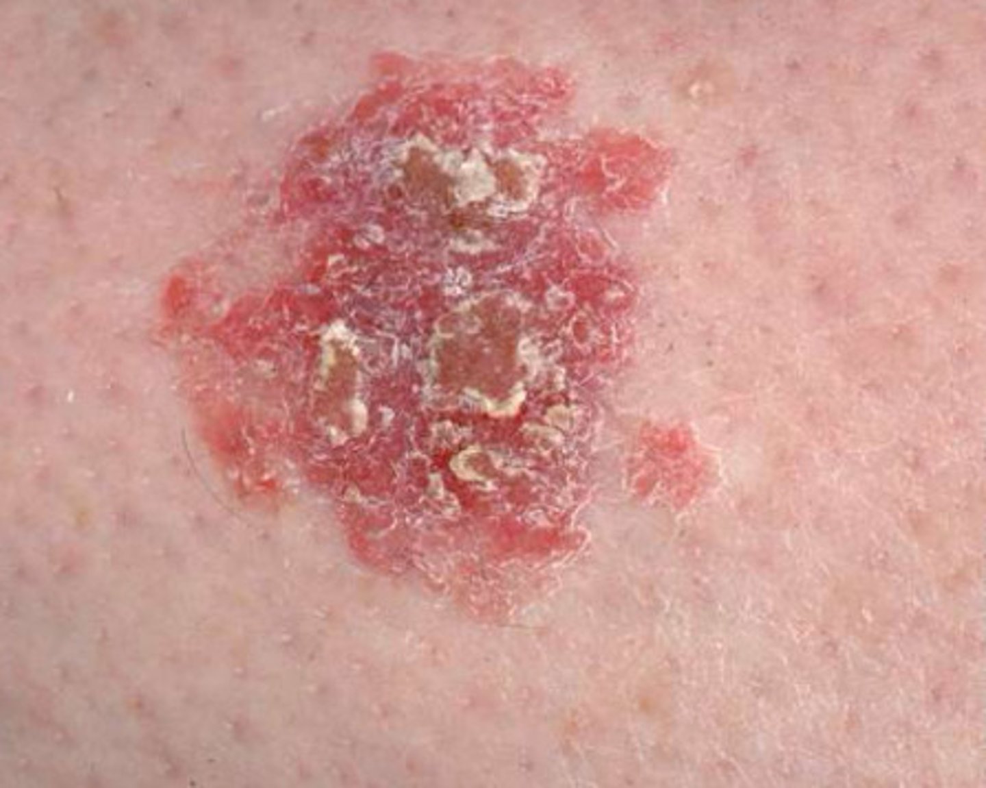 <p>-squamous cell carcinoma in situ (meaning it is in the superficial layer (epidermis)) and not extending into the dermis</p><p><strong>-potential for lateral spread</strong></p>