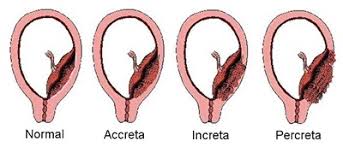 <p>Placenta Accreta</p>