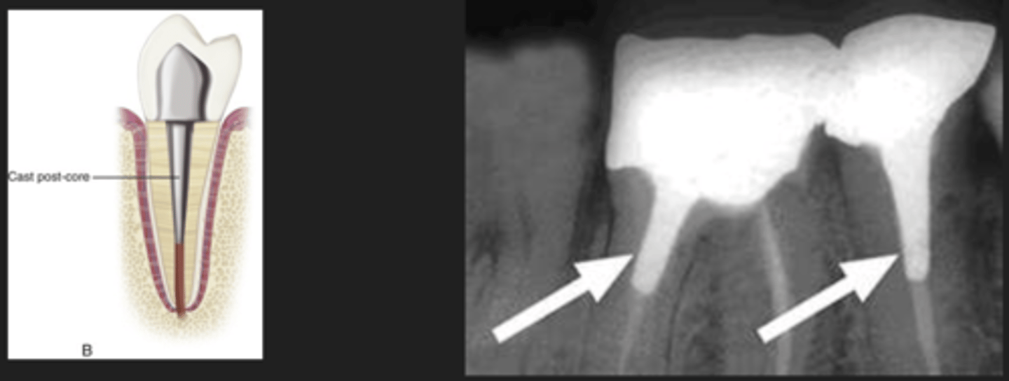 <p>- Metallic post and core that is cast at the lab</p><p>- Then seated in the root canal system and coronally to support tooth structure</p>
