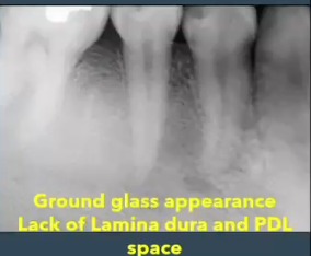 <p>lesion with <strong>ground glass appearance </strong>diagnosis?</p>