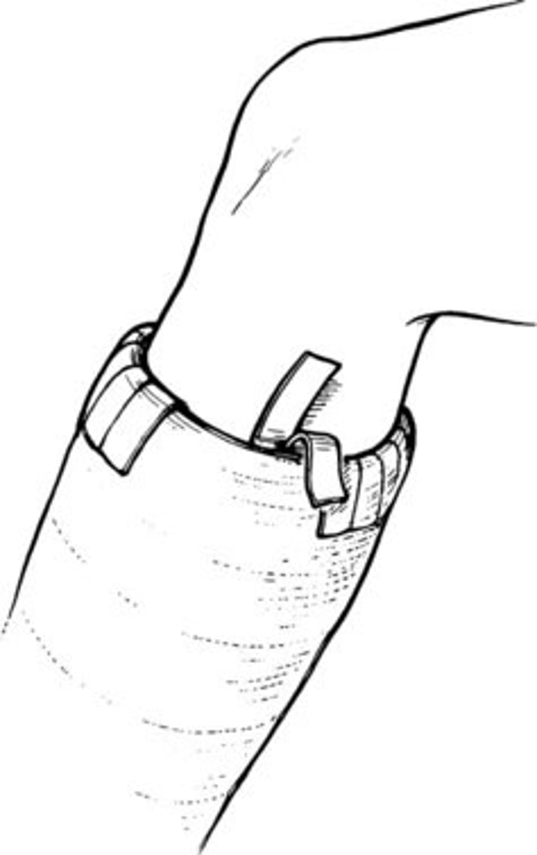 <p>Used to prevent edges of a cast from causing skin breakdown</p>