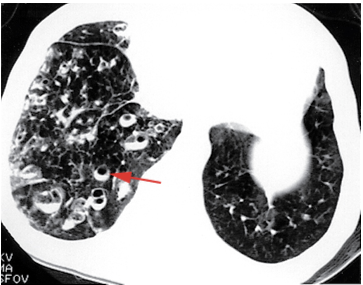 <p>What is the diagnostic test of choice for bronchiectasis?</p>