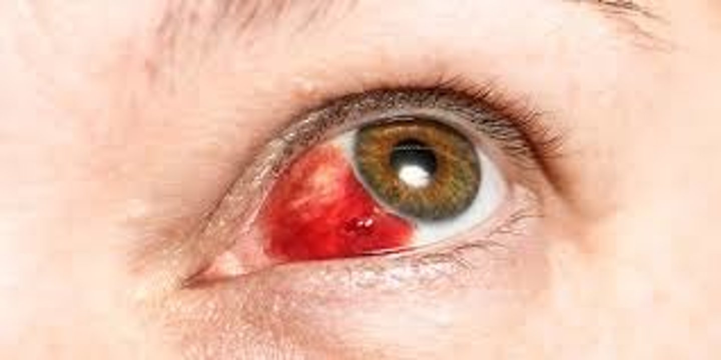 <p>red eye, from falling over or damage to eye, heals by itself</p>