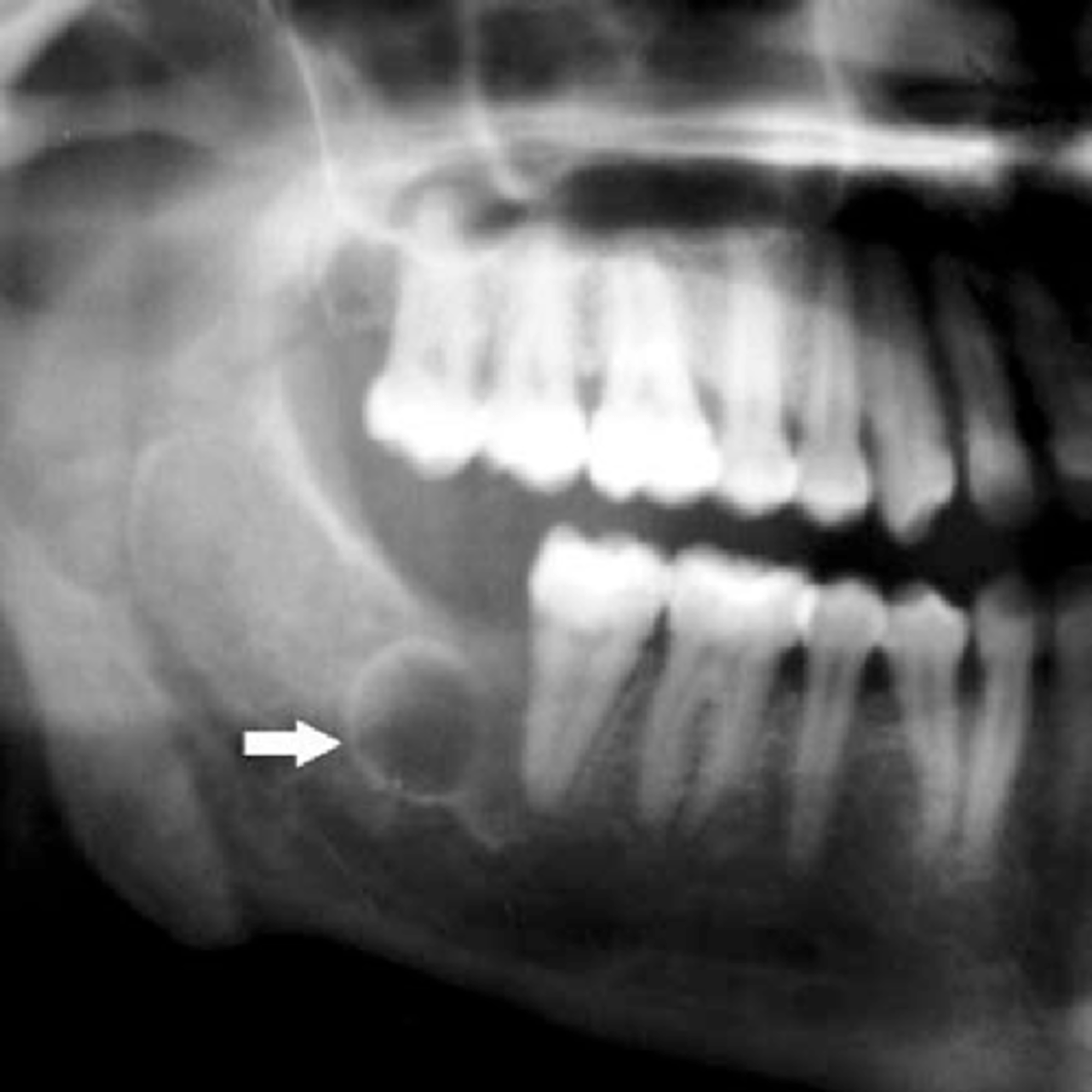 <p>the radiolucency in this radiograph appears to be a:</p><p>a. abscess</p><p>b. primordial cyst</p><p>c. dentigerous cyst</p><p>d. eruption cyst</p>