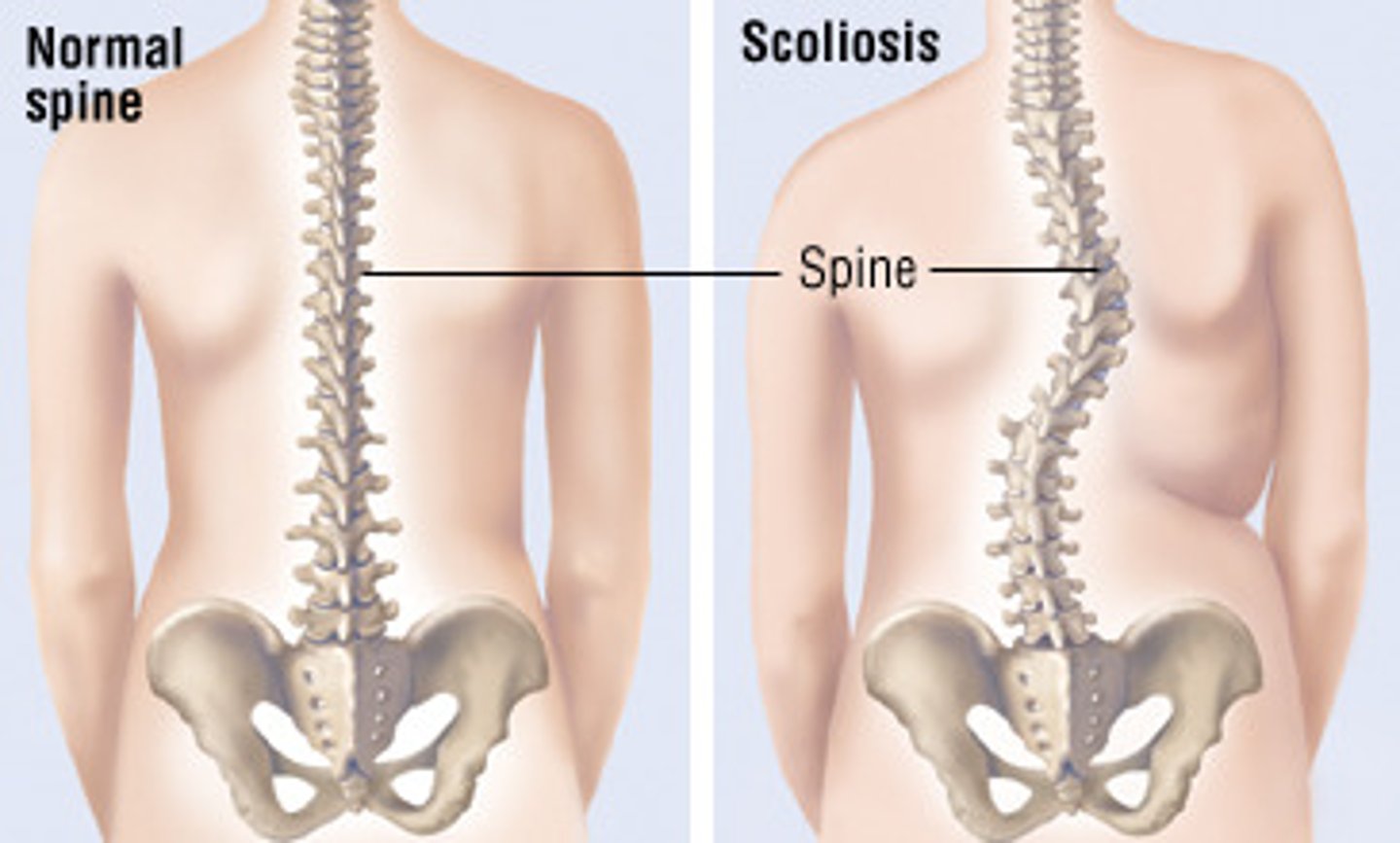 <p>Scoliosis = abnormal lateral curvature of the spine </p>