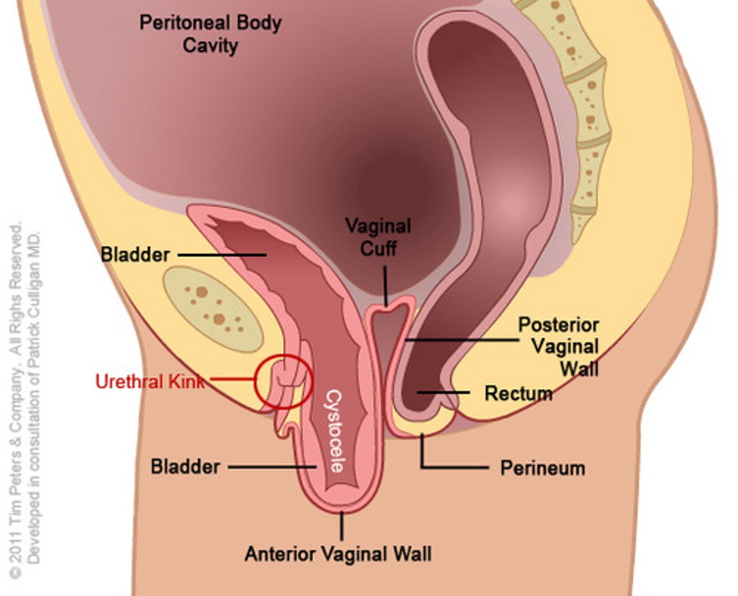<p>protrusion of the bladder</p>