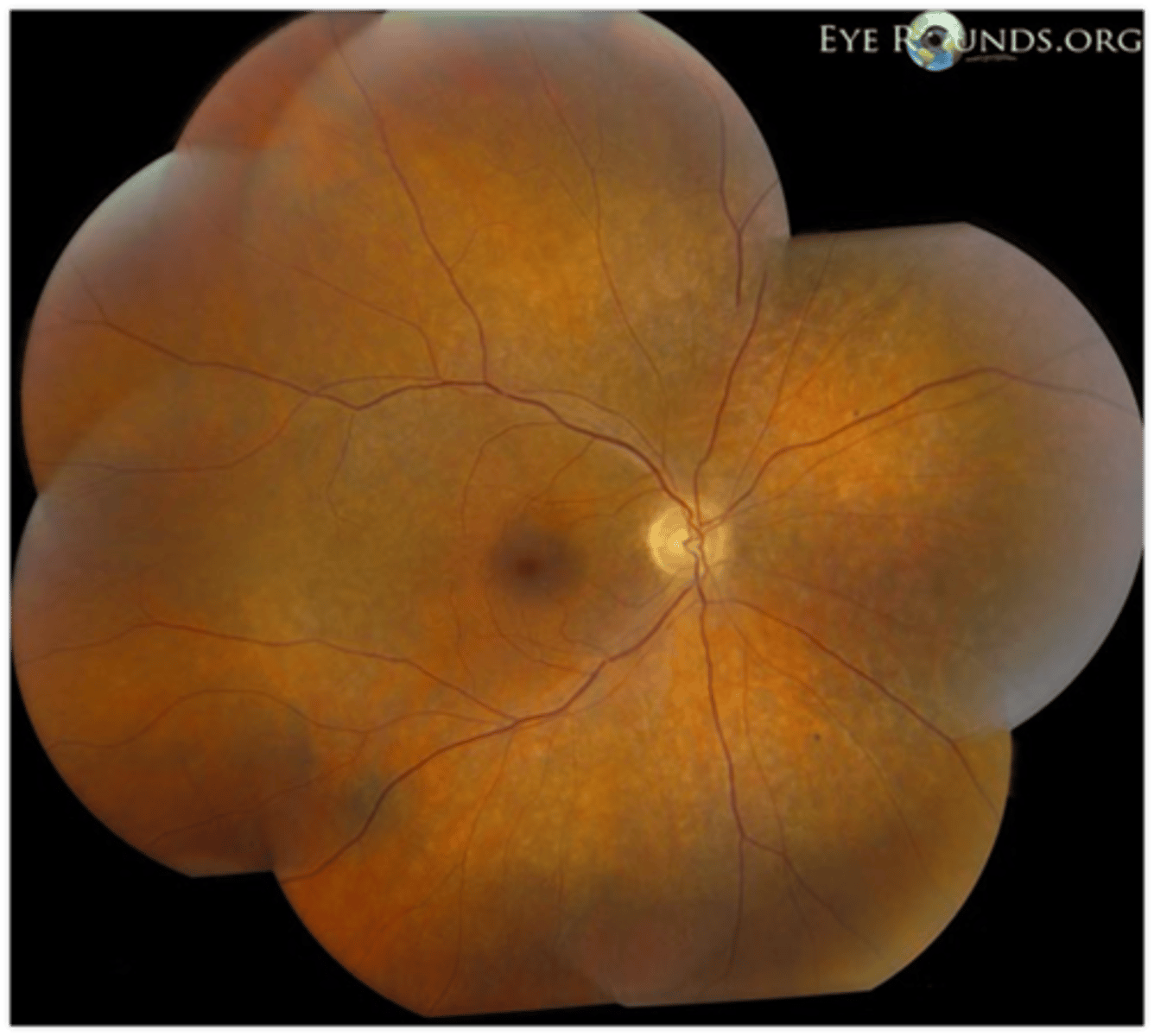 <p>variant of RP = absence of bone-spicule-like pigmentary changes, but still have artery attenuation and atrophy of RPE </p>