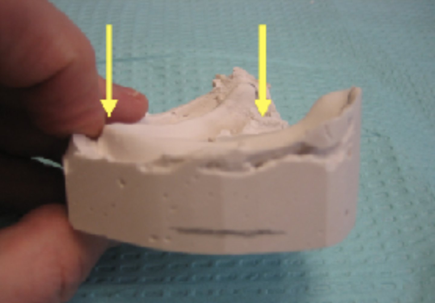 <p>Define the following:</p><p>________ is from the crest of the residual ridge in the anterior region to the area where the ascending rami begin in the posterior region.</p>
