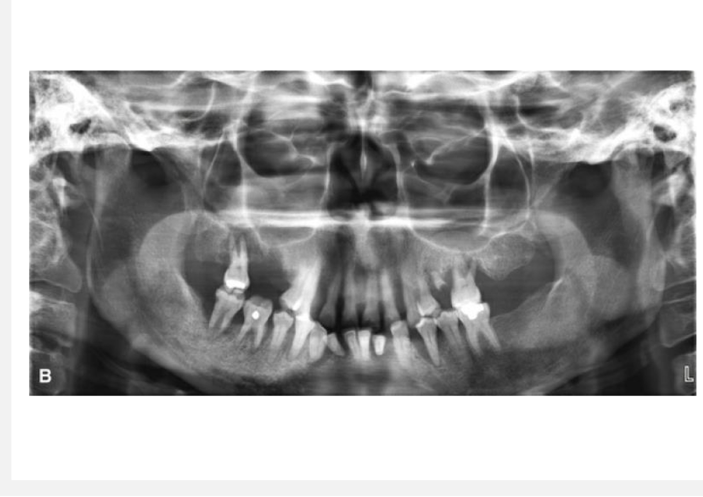 The anterior teeth are distorted and cutting off symphyseal region
