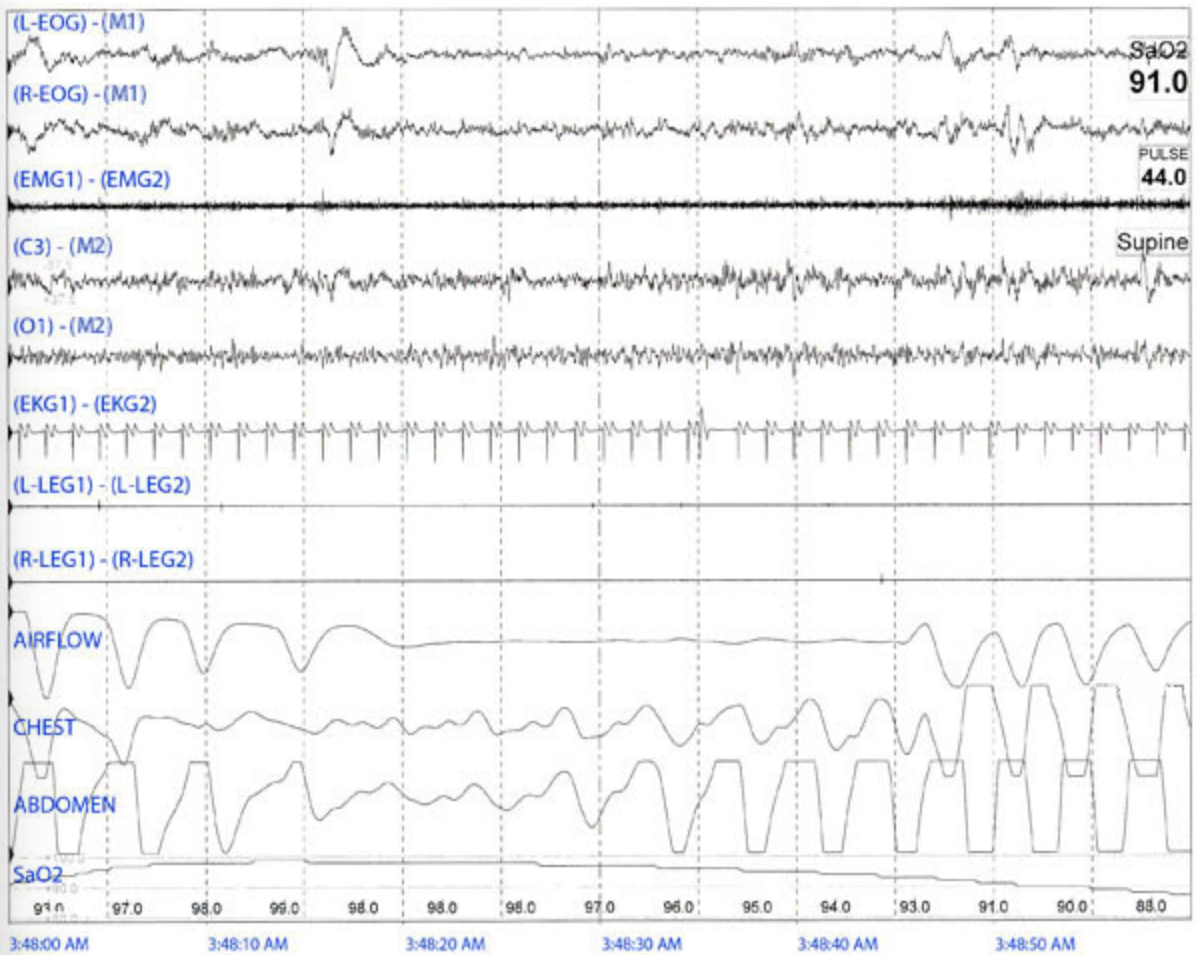 <p>The following 60 second tracing is observed for an adult during testing. Which of the following events in this tracing is of greatest concern? </p>
