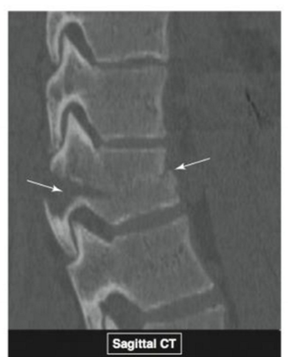 <p>What type of fracture is this? When does it occur?</p>