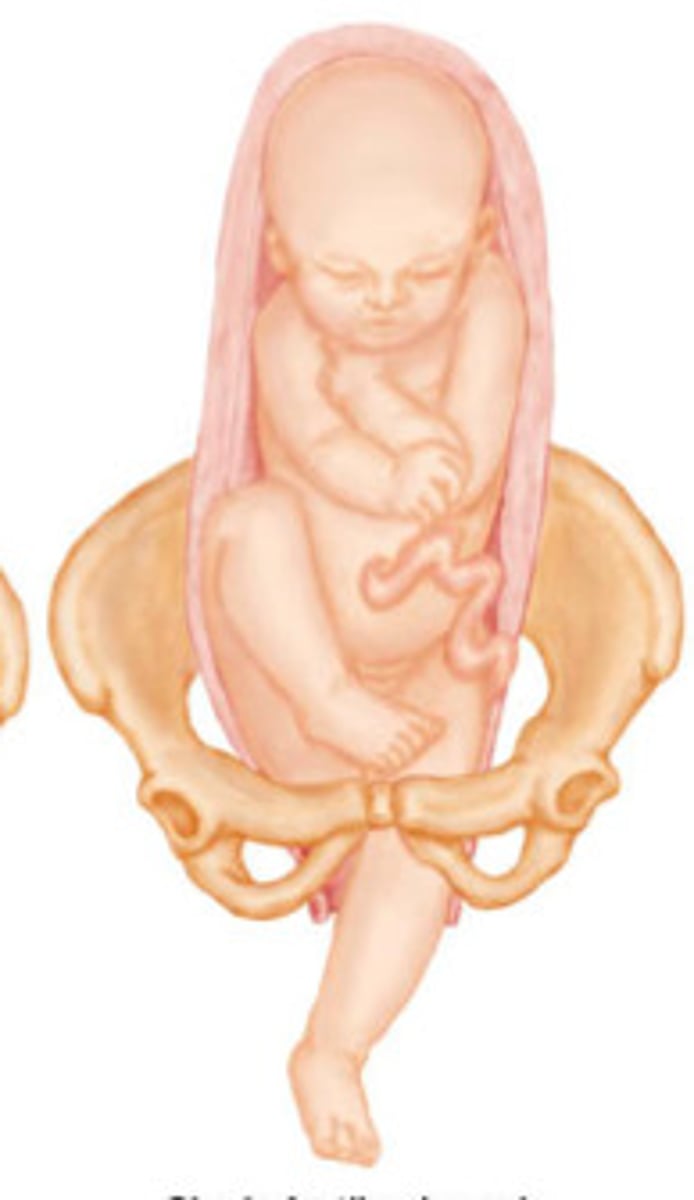 <p>occurs when one or both feet are presenting</p>