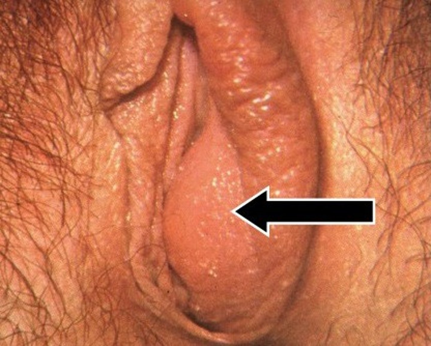 <p>- Bartholin's glands secrete vaginal lubricant. These ducts can become blocked/infected.</p><p>- This leads to cyst formation </p><p>- Usually caused by = E. coli. Can also be caused by STIs</p>