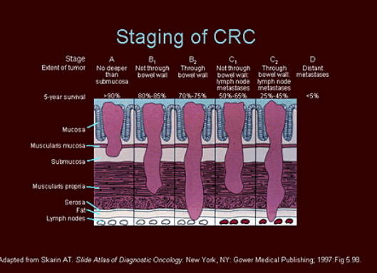 <ul><li><p>Dukes A: Confined to bowel wall </p></li><li><p>Dukes B: Invading into the<em> muscularis propria layer</em> or beyond, lymph node negative </p></li><li><p>Dukes C: Lymph node metastases </p></li><li><p>Dukes D: Distant metastases</p></li></ul><p></p>