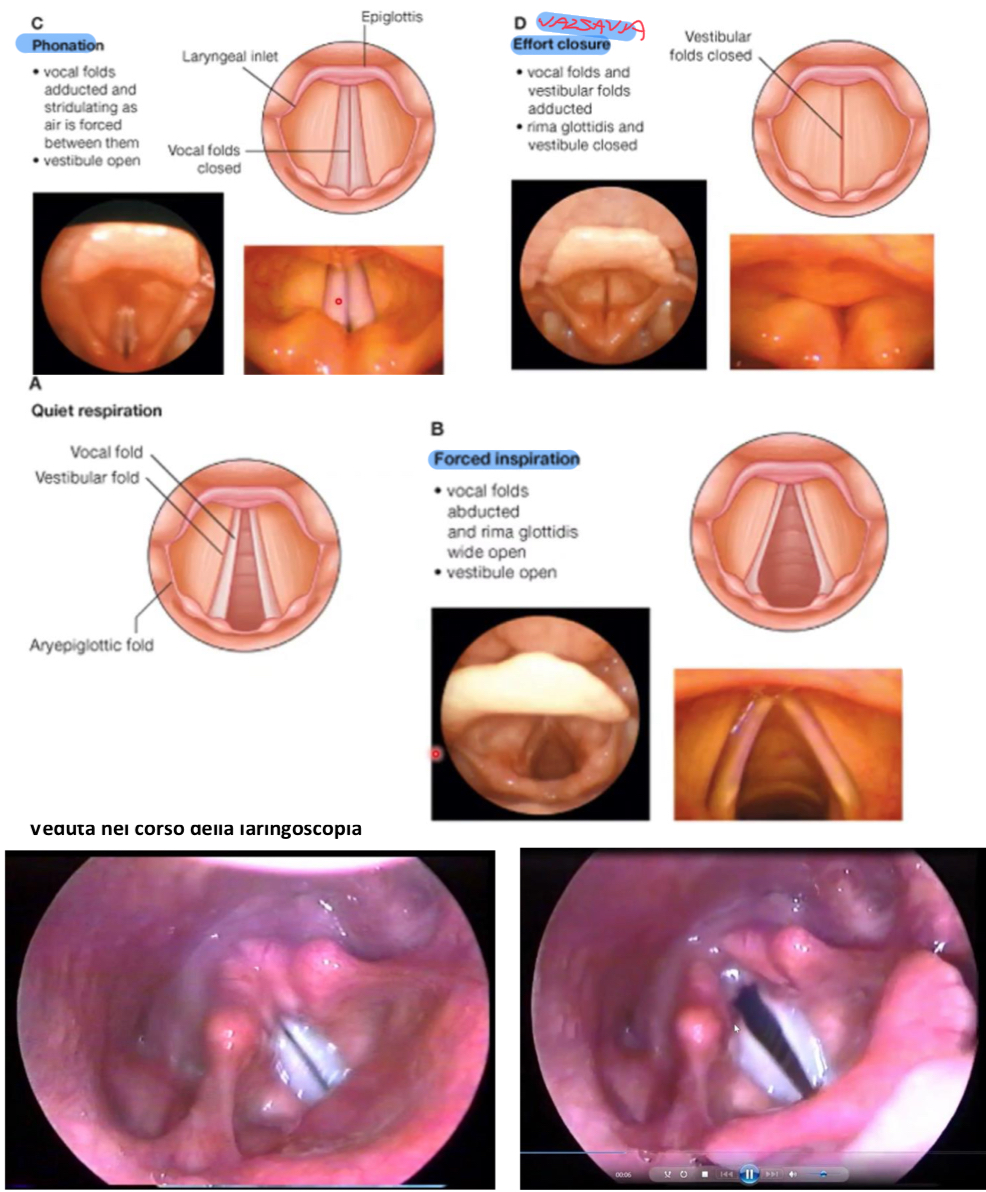 <p>Indiretta → con uno specchietto introdotto nella cavità orale, ma richiede il mantenimento della lingua del paziente</p><p>Con fibre ottiche → utilizza uno strumento che permette di osservare anche strutture più profonde</p><p>A respirazione forzata:</p><ul><li><p>L’epiglottide è sollevata</p></li><li><p>L’adito laringeo è aperto</p></li><li><p>Sarà visibile:</p><ul><li><p>Pieghe ariepiglottiche</p></li><li><p>Mucosa aritenoidi</p></li><li><p>Cartilagini corniculata e cuneiforme</p></li><li><p>Pieghe vestibolari, vocali e ventricolo laringeo</p></li></ul></li><li><p>Le pieghe vocali, a differenza dell’epitelio diverso dal resto della mucosa, ha un colore diverso:</p><ul><li><p>bianco brillante</p></li><li><p>zona priva di vasi e il nutrimento avviene per diffusione</p></li></ul></li></ul><p>Durante la fonazione:</p><ul><li><p>Le pieghe vocali si avvicinano e l’aria che passa fa vibrare i margini vocali producendo il suono</p></li></ul><p>Manovra di Valsavia (trattenere l’aria):</p><ul><li><p>Pieghe vocali e vestibolari si adducono → quelle vestibolari coprono le vocali</p></li><li><p>Blocco completo del passaggio dell’aria e aumento pressione toracica e addominale</p></li></ul><p>Deglutizione:</p><ul><li><p>I muscoli estrinseci della laringe la sollevano</p></li><li><p>L’epiglottide si abbassa </p></li><li><p>L’adito laringeo si chiude</p></li><li><p>Il bolo viene deviato nell’esofago.</p></li></ul><p></p>