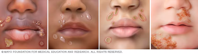 <p>MC to face, nose, mouth, arms, legs </p><ol><li><p>small red bumps that develop into blisters </p></li><li><p>can break open and release clear or yellow exudative that forms </p></li><li><p>crust, honey-colored sores that may spread </p></li><li><p>itchy </p></li><li><p>rarely swelling of lymph nodes near affected sites and fever  </p></li></ol><p></p>