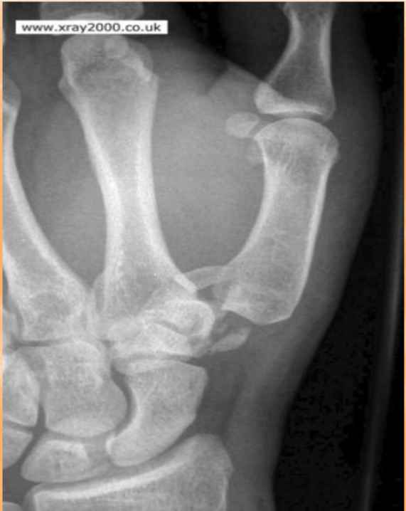 <p>“Fun Film” trapezium fracture </p>