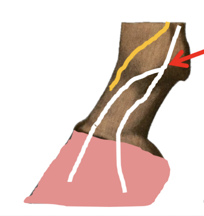 <ul><li><p>Aim to block the palmar digital nerve <strong>before it branching off</strong> dorsal and palmar branches </p><ul><li><p>= Block the entire foot (Includes the dorsal branches of the palmar digital arteries)</p></li></ul></li><li><p>2 points of injections</p><ul><li><p>Medial and lateral palmar digital nerves</p></li></ul></li><li><p>Location:</p><ul><li><p>Right beside the abaxial aspect of sesamoids = Around the fetlock joint</p></li></ul></li></ul><p></p>