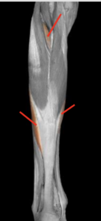 <p>soleus </p>