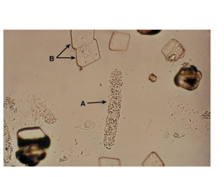 <p><span>Granular Casts</span></p>