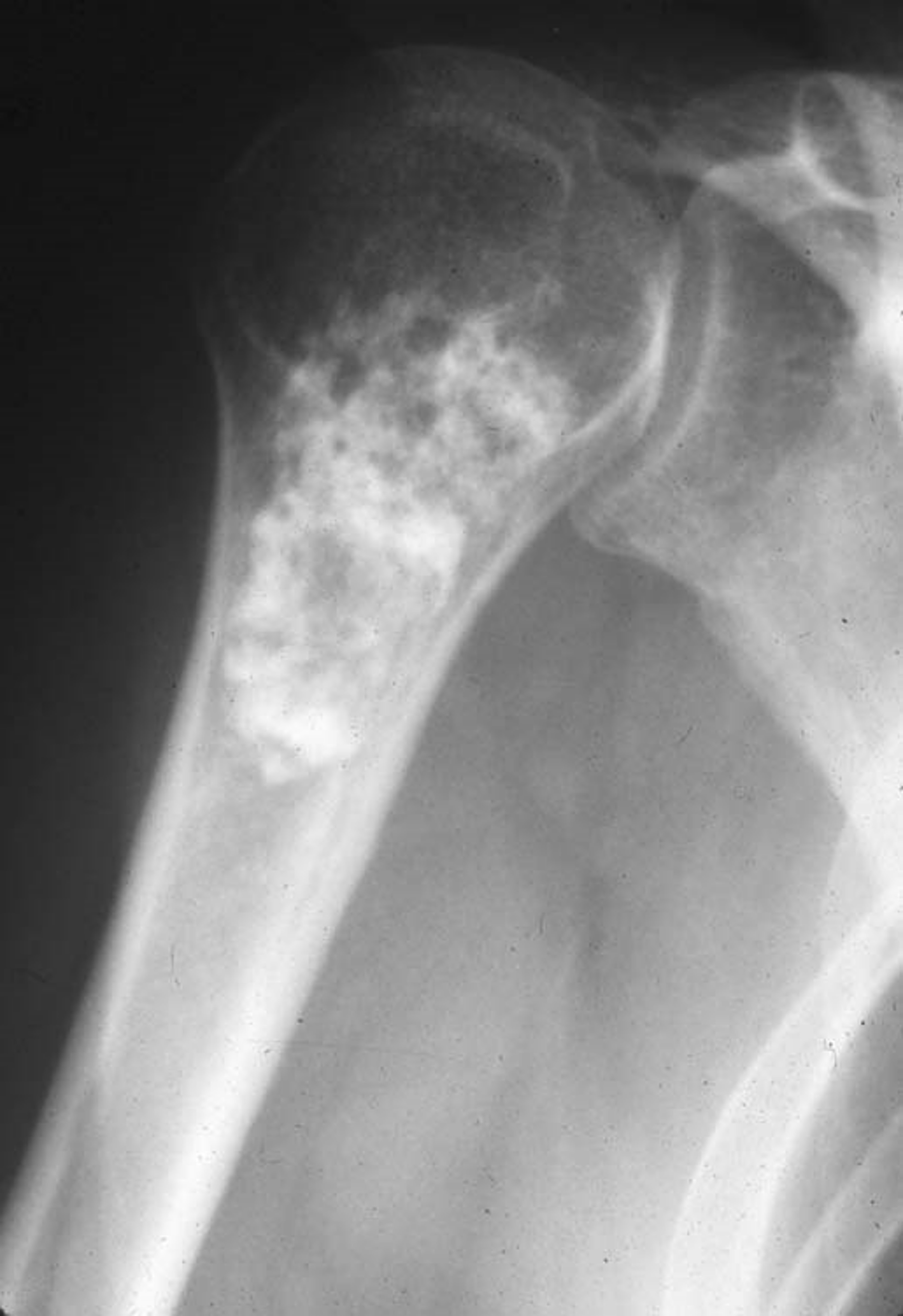 <p>Enchondroma (tumor)</p>