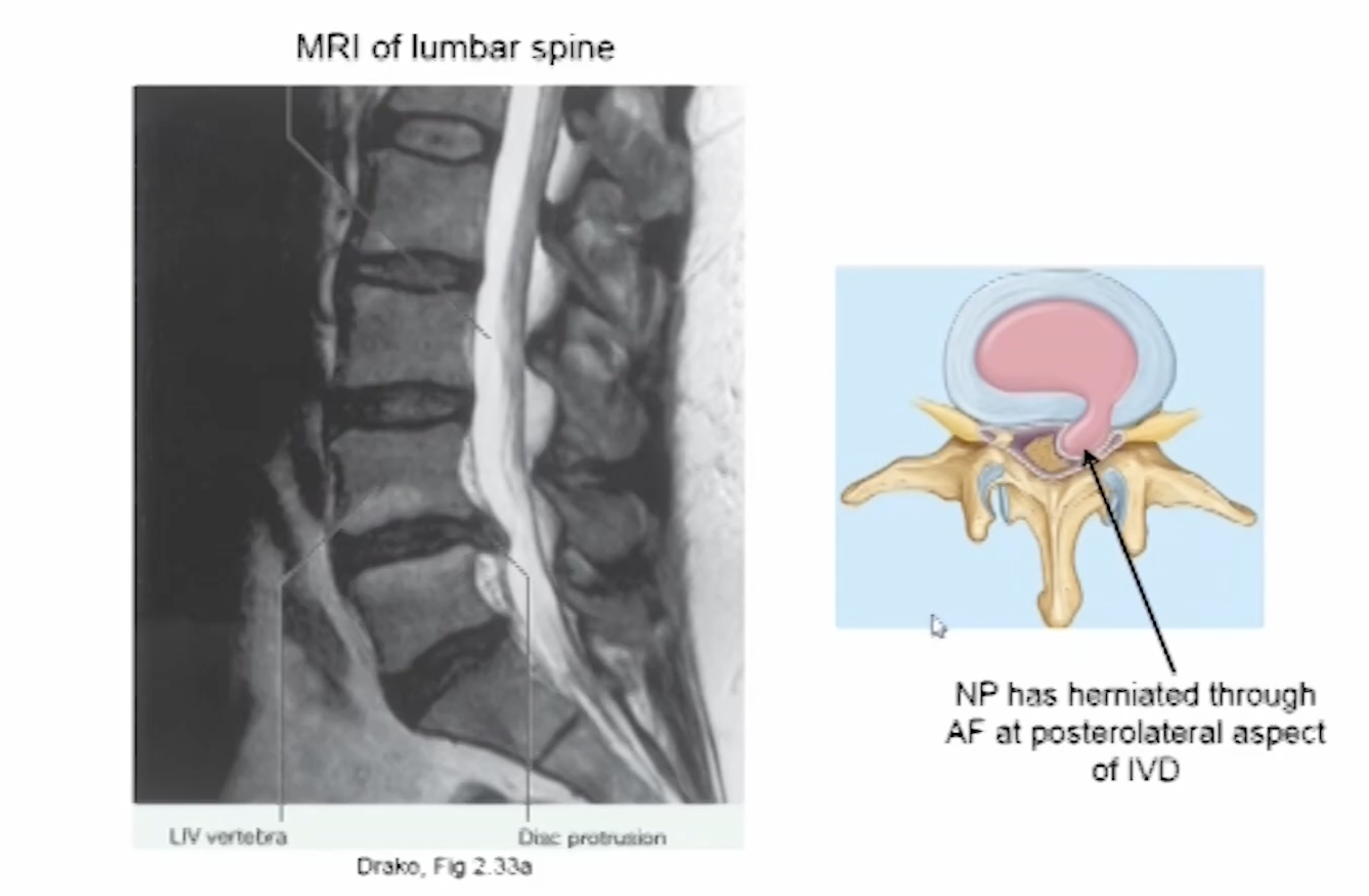 <p>Means that part of the annulus fibrosis has been overstretched and damaged and the nucleus pulposus is able to push out. It often happens with flexion combined with rotation movements. Most common in cervical and lumbar regions because they have the greatest range of movement</p>