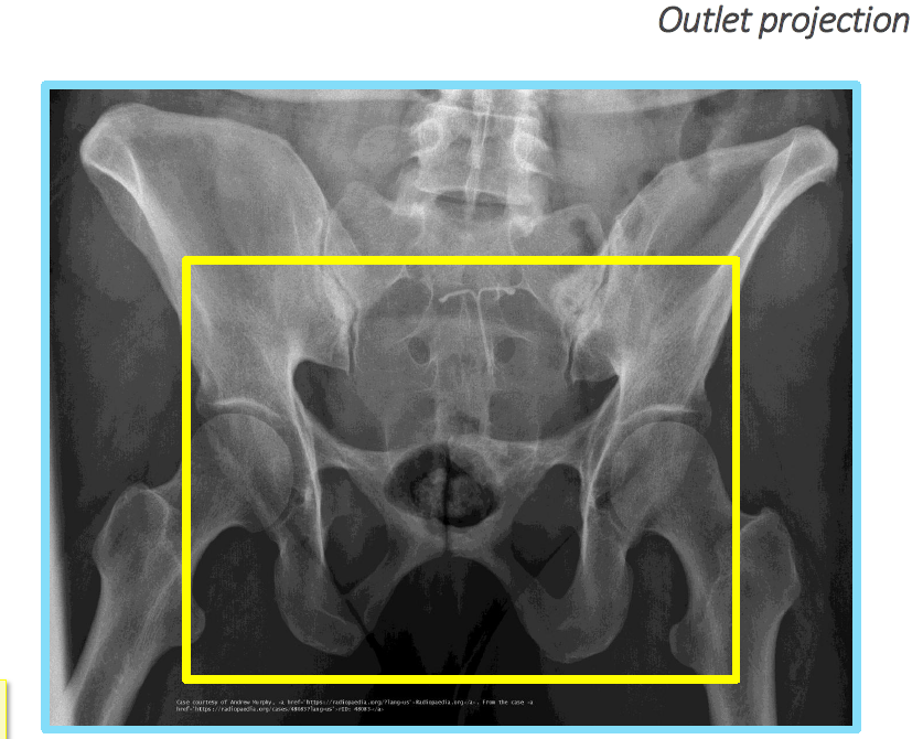 <p>Pubic and ischial bones, hip joints.</p>