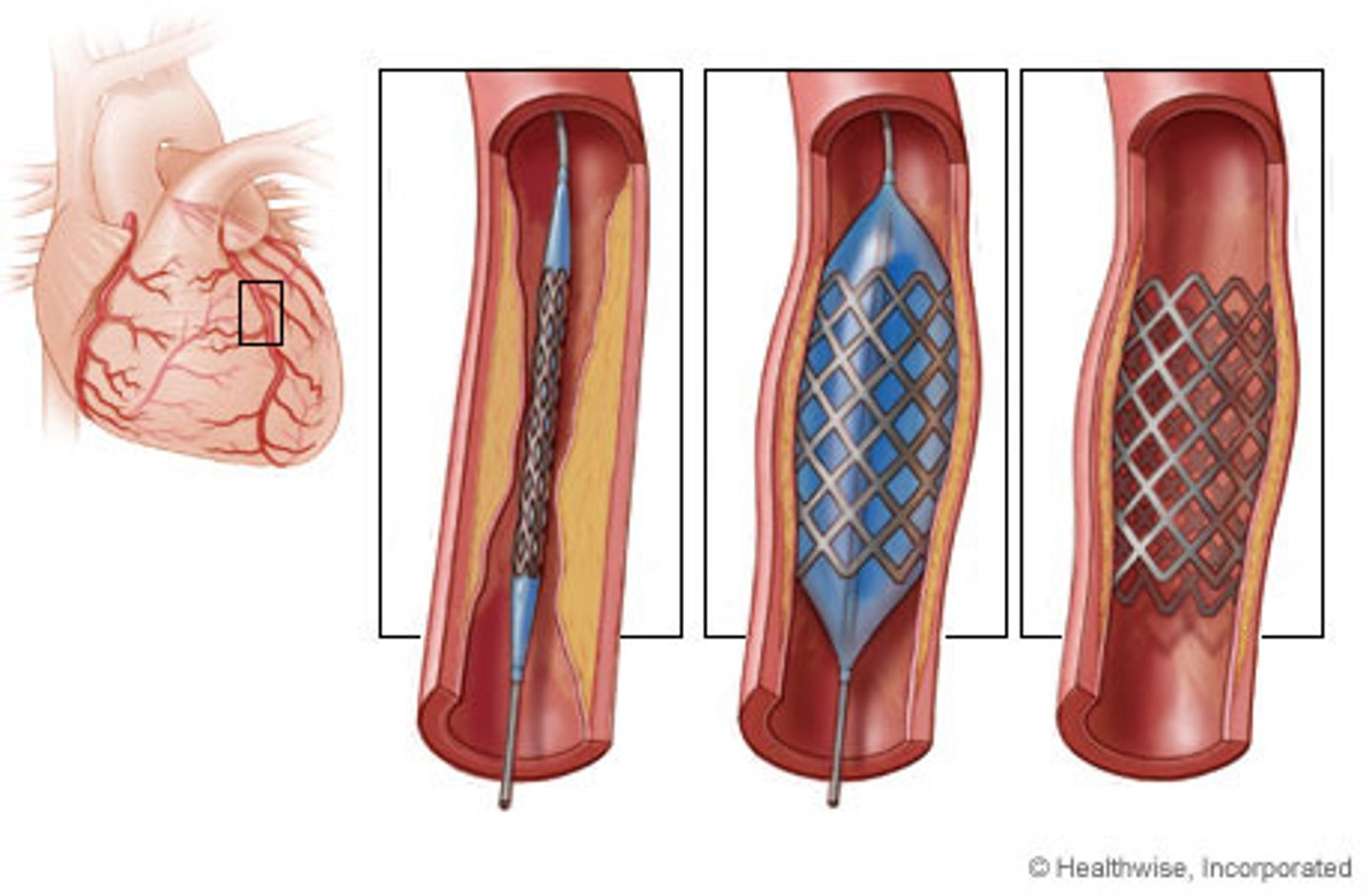 <p>Stents.</p>