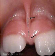 <p>Fold of mucus membrane, attached to movable tissue to more fixed</p><p>tissue.</p>