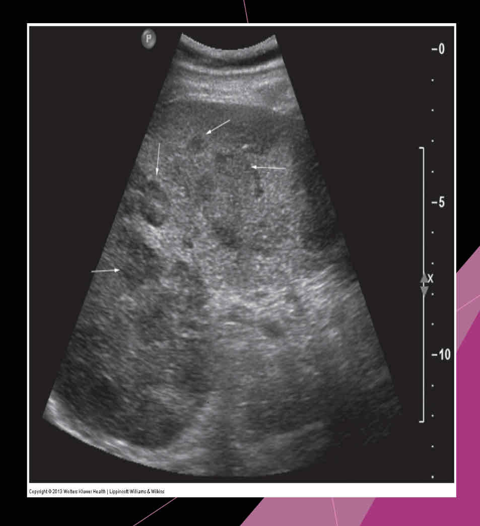 <p>What may also occur with ovary, breast, lung, pancreas and stomach primaries, and Sonographically: hypoechoic is common, but it may vary?</p>