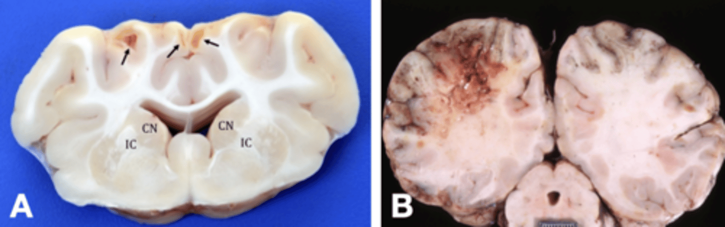 <p>- "Softening"; Pan-necrosis of all cell types (neurons and glia) which results in grossly visible softening or liquefaction o the tissue</p>