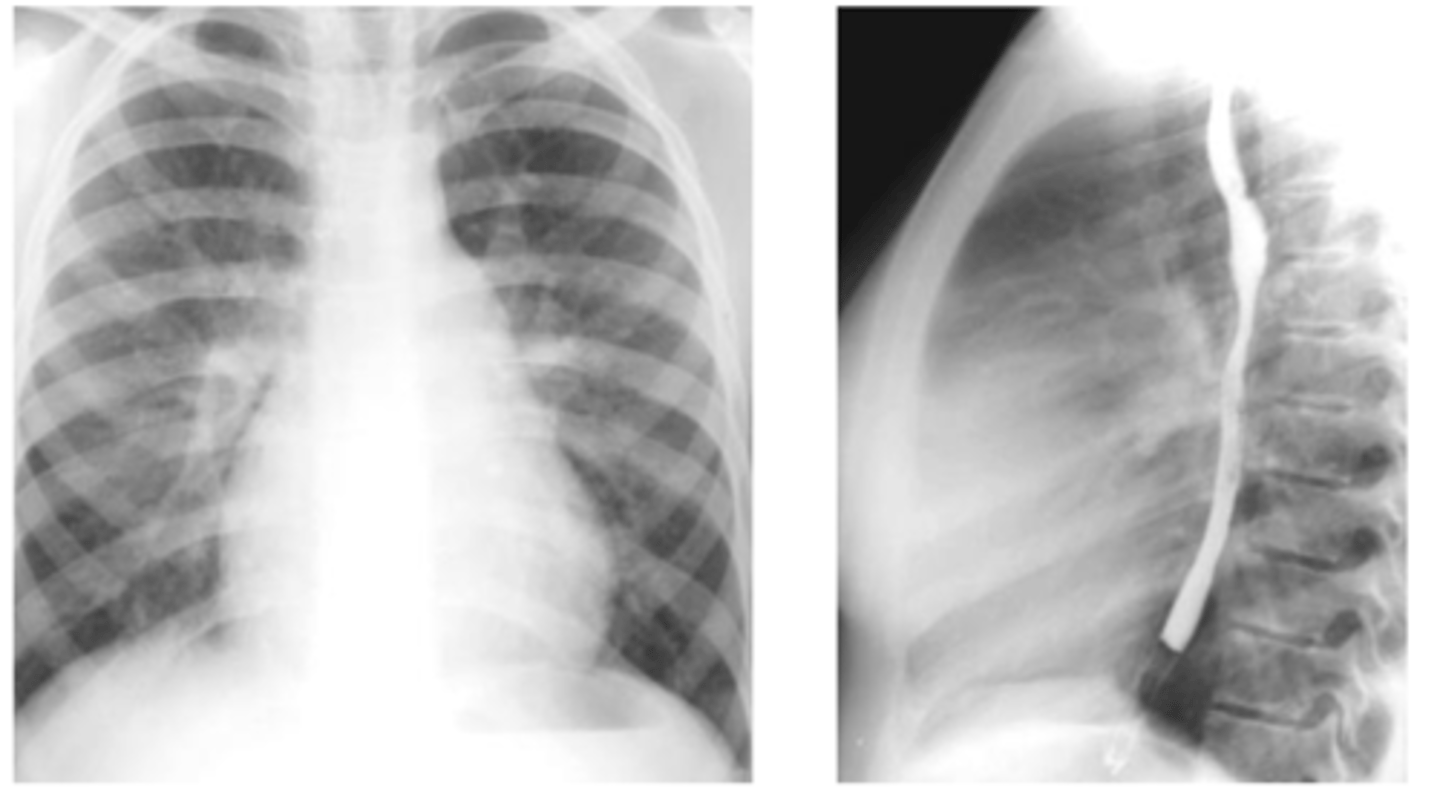 <p>-pulmonary artery</p><p>enlargement, right atrial and right ventricular enlargement.</p><p>-Film shows filling-in of retrosternal space and</p><p>increased size of the pulmonary artery.</p>