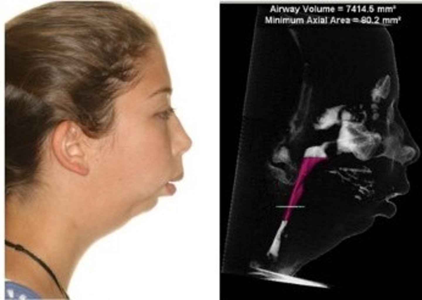 <p>Small chin and no room for tongue</p>