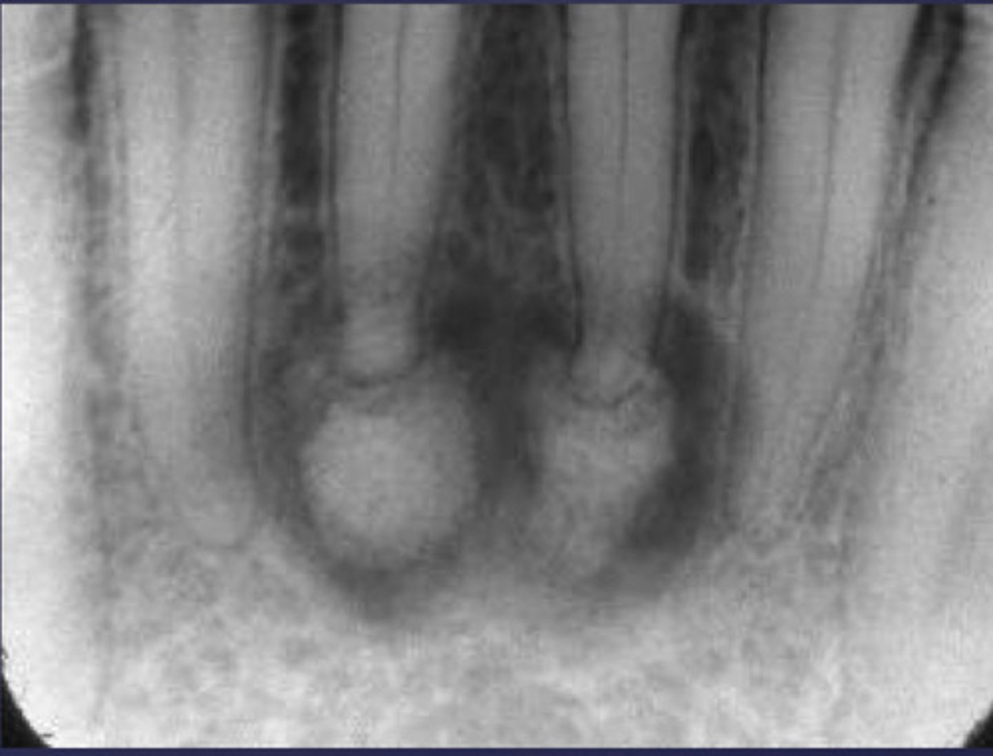 <p>How would you describe the following lesion?</p>