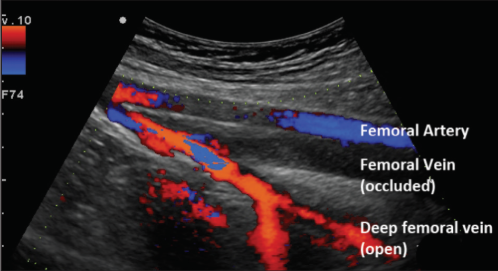 <p>Is this image sufficient to diagnose DVT? Explain </p>